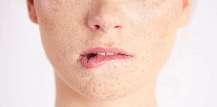 Xeroderma Pigmentosum: Gejala, Penyebab, dan Penanganan