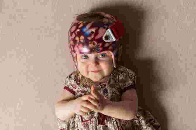 terapi helm untuk craniosynostosis