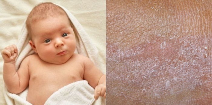 Epidermolysis Bullosa: Gejala, Faktor Risiko, hingga Pencegahannya
