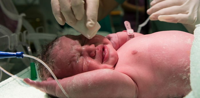 Penyakit Jantung Bawaan pada Bayi, Apakah Harus Dioperasi?