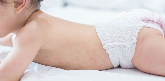 Bunda, Yuk Ketahui Penyebab dan Cara Mengatasi Kulit Kering pada Bayi dengan Tepat