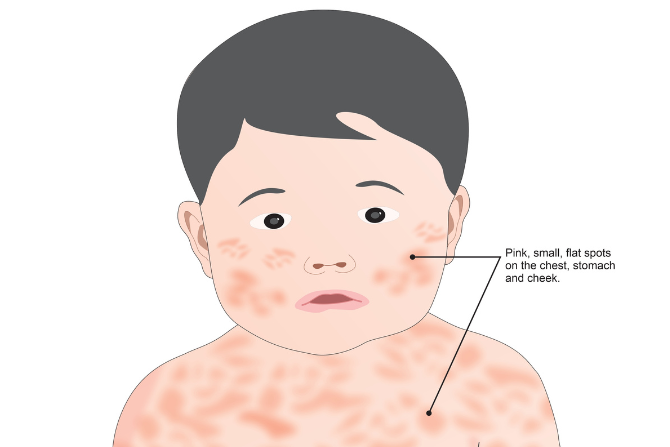 Roseola Infantum pada Bayi