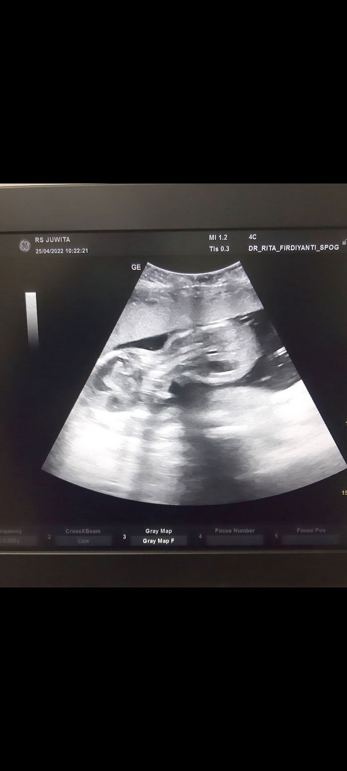 Drama Kehamilan Keduaku