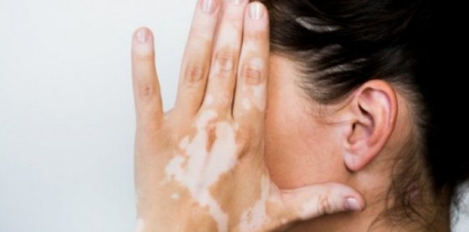 Disebut Luka Bakar di Kehidupan Sebelumnya, Ini Penjelasan Mitos Tanda Lahir Putih