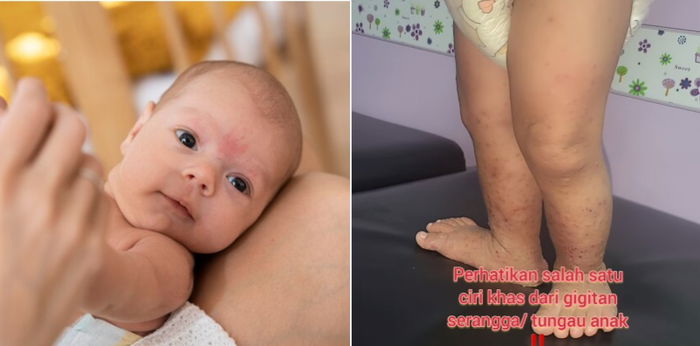 Dikira Alergi, Bayi 4 Bulan Alami Luka Parah Akibat Tempat Tidur yang Dipenuhi Serangga