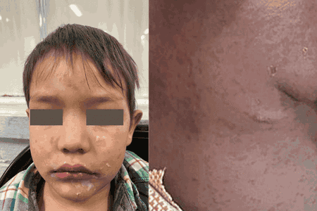 Ini Ciri dan Gambar Bintik Campak pada Anak, Ketahui Cara Mencegahnya!