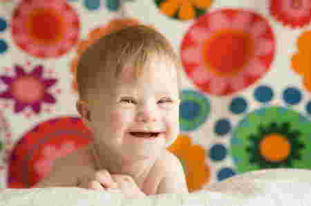 Penyakit Down Syndrome pada bayi
