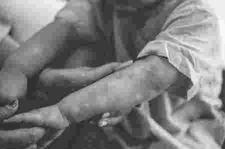 Gambar cacar monyet pada anak