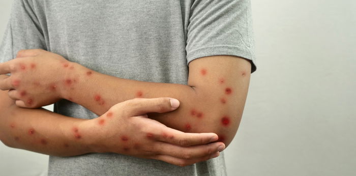 Waspada, Ini Gambar dan Ciri-Ciri Cacar Monyet pada Anak!