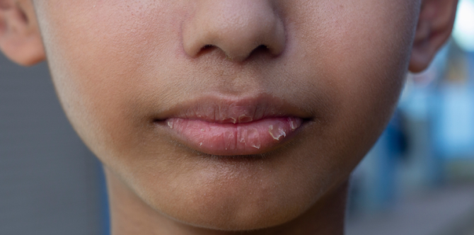 Dehidrasi pada Anak Apakah Bisa Sembuh Sendiri?