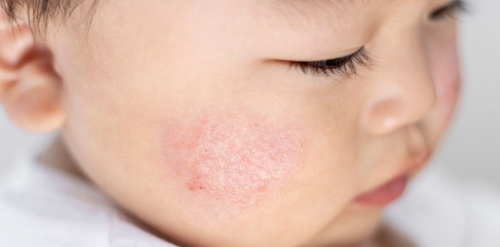 Penyebab Bercak Putih pada Kulit Bayi, Apakah Bisa Hilang? Ini Jawabannya!