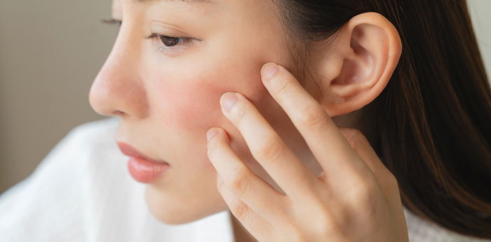 Cara Menghilangkan Bekas Jerawat Merah atau PIE, Bisakah Pudar Sendiri?