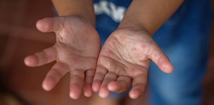 Kenali Gejala HFMD atau Flu Singapura pada Bayi dan Pengobatannya yang Tepat
