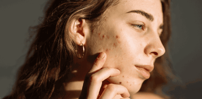 5 Cara Ampuh dan Cepat Menghilangkan Bekas Jerawat Hitam