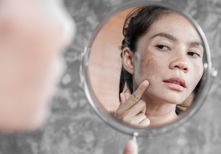 menghilangkan bekas jerawat hitam