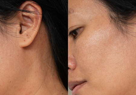 5 Cara Ampuh dan Cepat Menghilangkan Bekas Jerawat Hitam