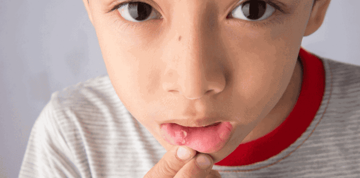 Hati-Hati, Ini 10 Makanan Penyebab Sariawan pada Anak