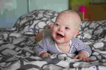 Berat badan down syndrome