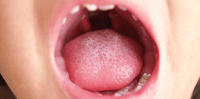 5 Ciri Ciri Amandel Normal pada Anak dan Bermasalah