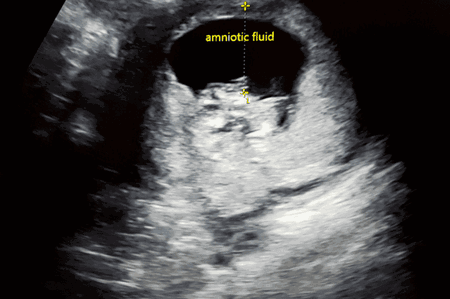 ciri-ciri air ketuban berkurang 1