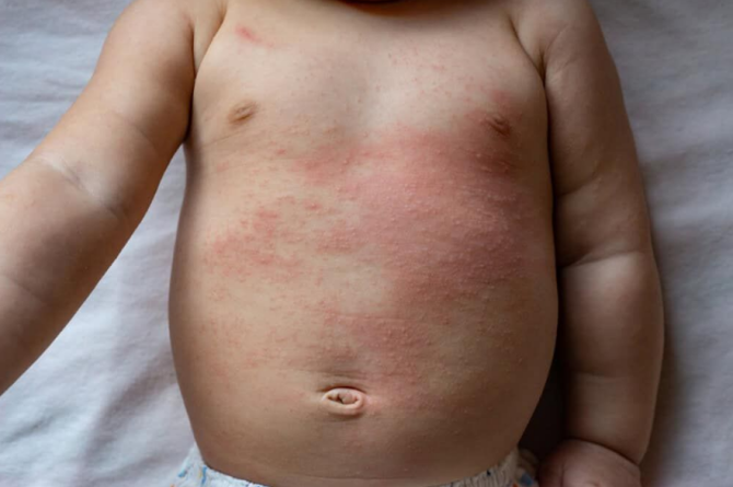 Detergen kulit bayi newborn mudah ruam