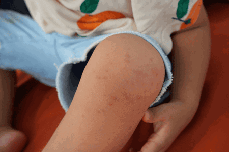 3 Ciri Flu Singapura Sudah Sembuh yang Terlihat Jelas