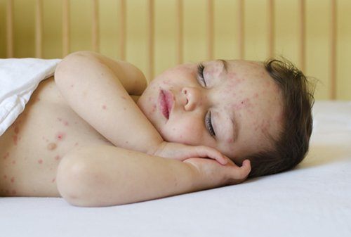 10 Penyakit Pada Anak yang Paling Sering Menular