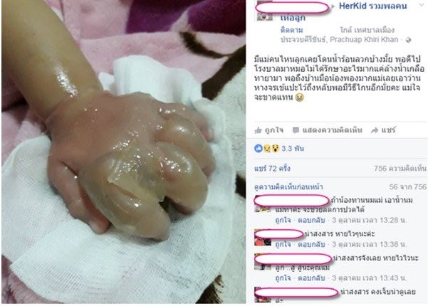 ทำอย่างไร เมื่อลูกโดนน้ำร้อนลวก