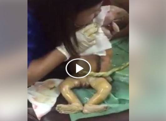 เปิดคลิปนาทีชีวิต "ทารกแรกเกิด" ที่คุณหมอสามารถยื้อไว้ได้