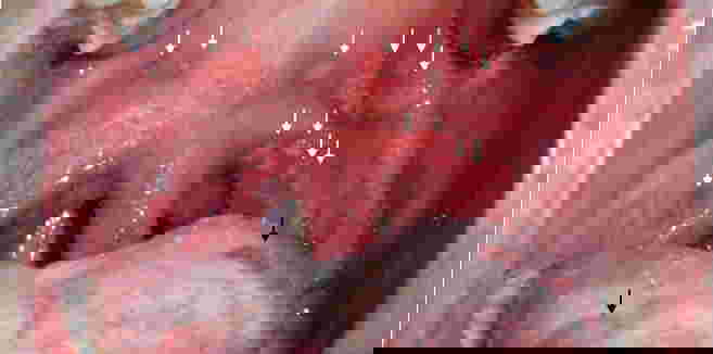 เฮอร์แปงไจนา