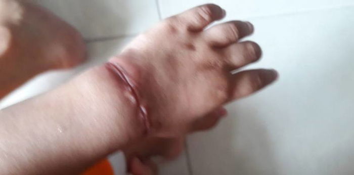 ยางรัดผม รัดข้อมือ กินเข้าไปในเนื้อของลูก เตือนภัย! ลูกใครชอบเล่นหนังยางมารัดข้อมือเล่น