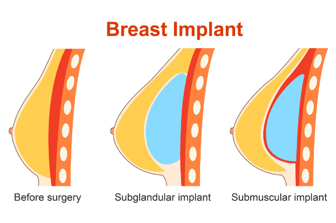 เสริมหน้าอกให้นมลูกได้ไหม