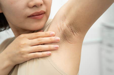 dark armpits during pregnancy