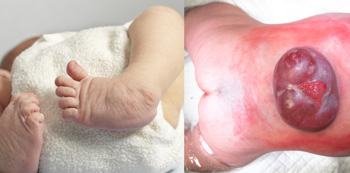 5 นิสัยอันตรายที่ทำให้ ลูกพิการแต่กำเนิด ระวังเด็กพิการแต่กำเนิด