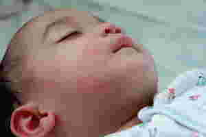 heat rash in babies