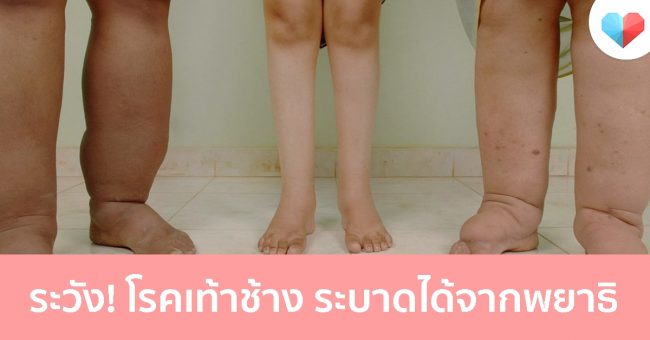 โรคเท้าช้าง โรคระบาดจากพยาธิ เกิดขึ้นได้อย่างไร และโรคเท้าช้างรักษาได้