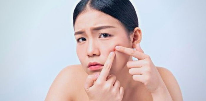 สิวเกิดจากอะไร ปัญหากวนใจระดับชาติ สิวมีกี่ชนิด ?