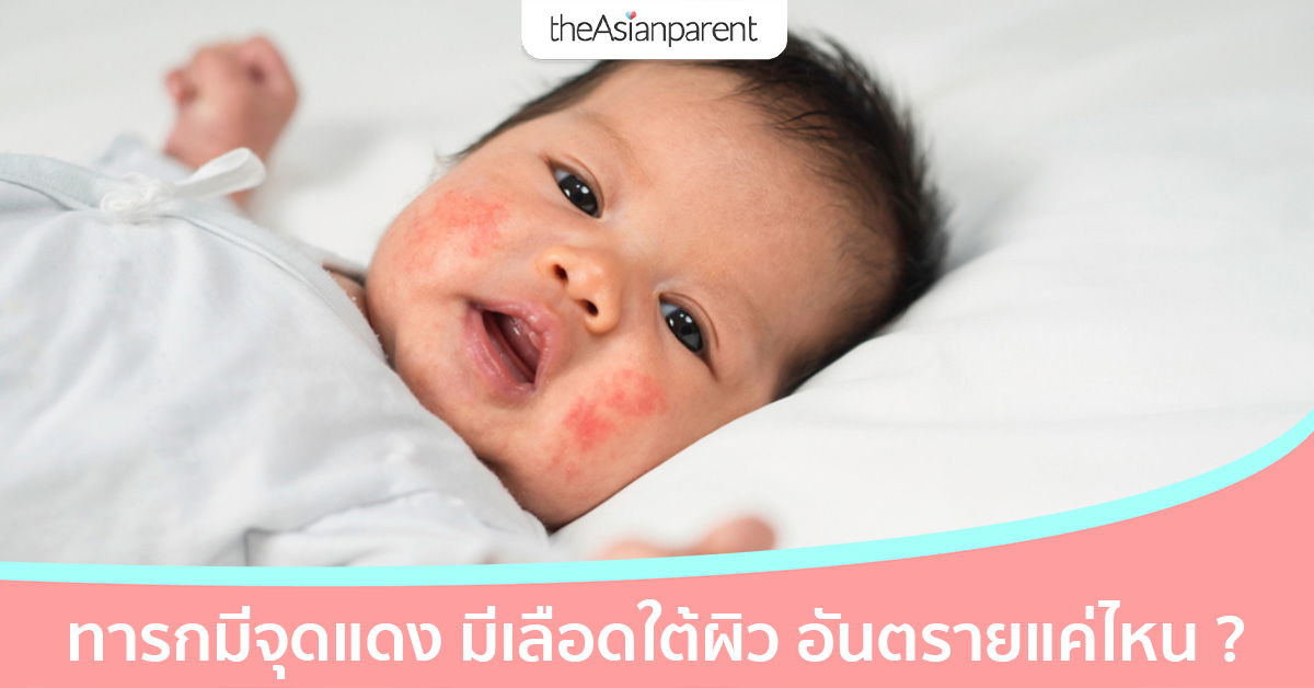 เลือดออกใต้ผิวหนังทารก จุดแดงใต้ผิวหนัง คืออะไร อันตรายไหม