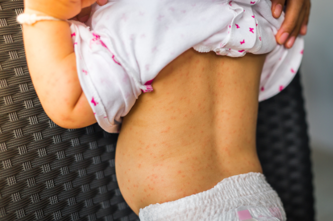 หมอผิวหนังเด็ก