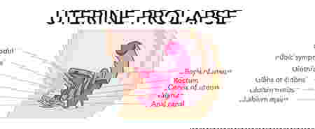 symptoms of uterine prolapse