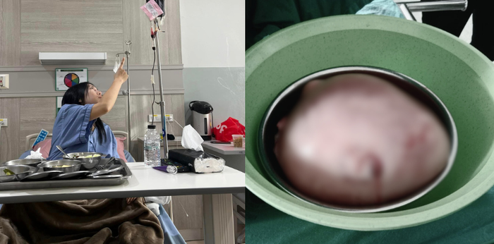 หญิงสาวคิดว่าอ้วนลงพุง ตรวจพบ “เนื้องอกในมดลูก” ขนาดเท่ากะละมัง!