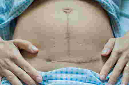 scar reduction medication for cesarean