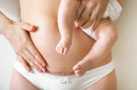 ผ่าคลอด น้ำคาวปลาจะหมดตอนไหน