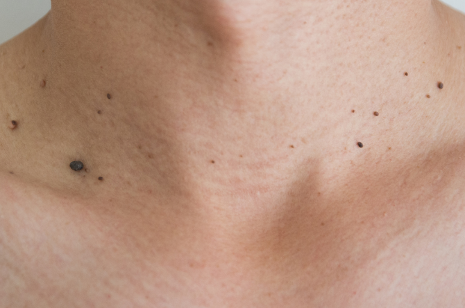 ติ่งเนื้อตอนท้อง