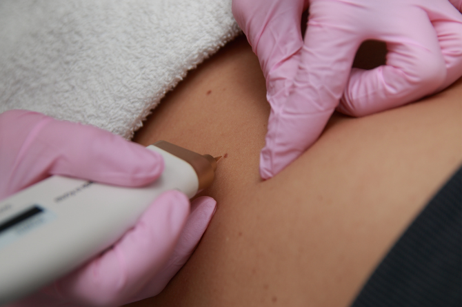 วิธีรักษาติ่งเนื้อ