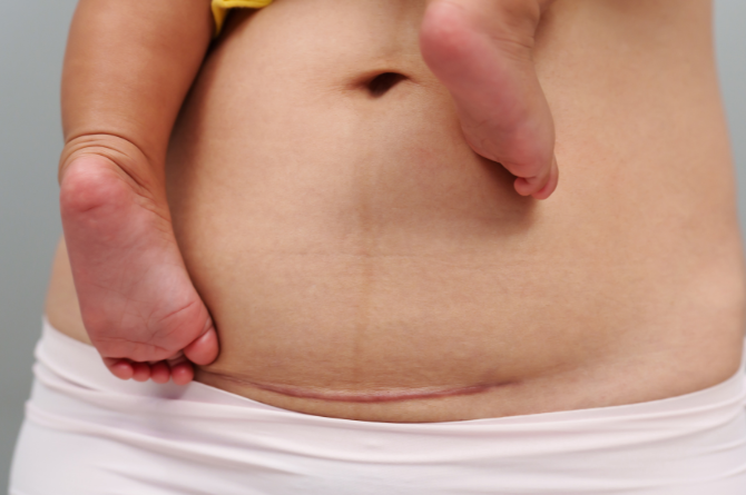 แผลคีลอยด์ คืออะไร