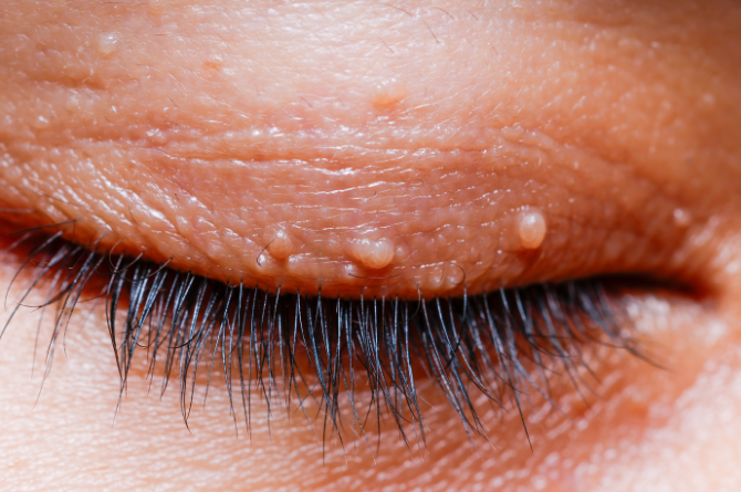 ติ่งเนื้อ คืออะไร