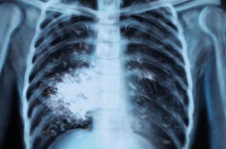 lung cancer on women