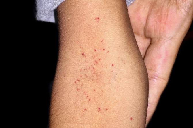 จุดแดงตามตัว