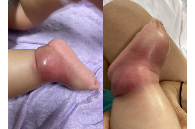 อุทาหรณ์ลูกเป็นหวัด